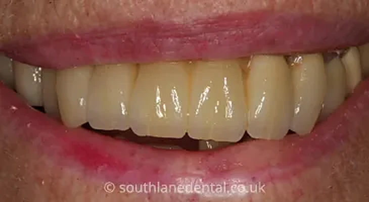 Case 1: teeth after a dental bridge at South Lane Dental