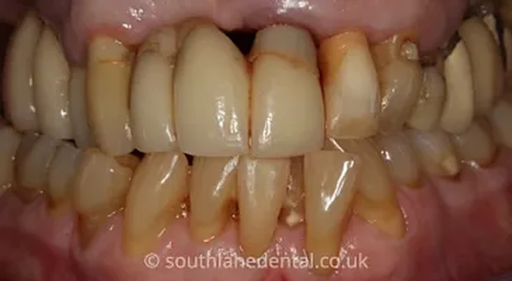 Case 1: teeth before a dental bridge at South Lane Dental