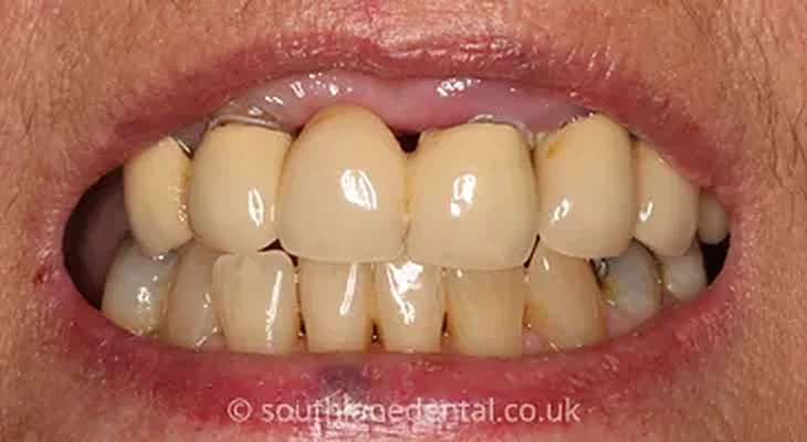 Case 2: teeth before a dental bridge at South Lane Dental