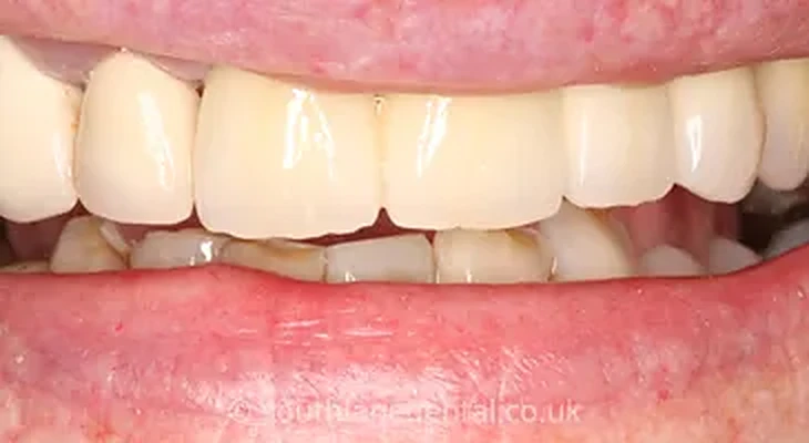 Case 3: teeth after a dental bridge at South Lane Dental
