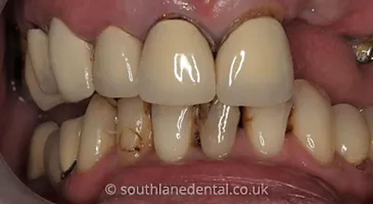 Case 3: teeth before a dental bridge at South Lane Dental