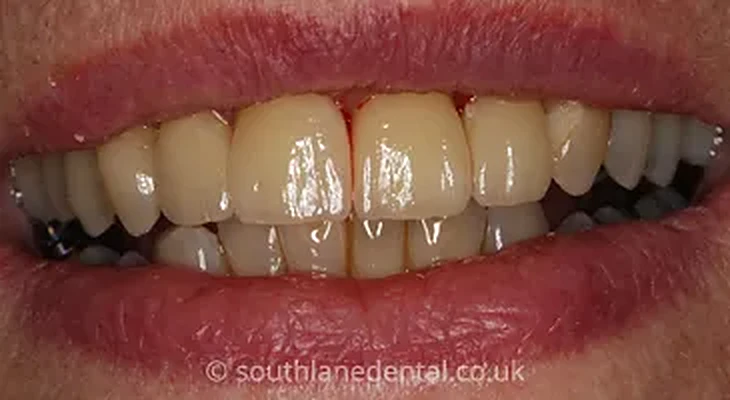 Case 4: teeth after a crown at South Lane Dental