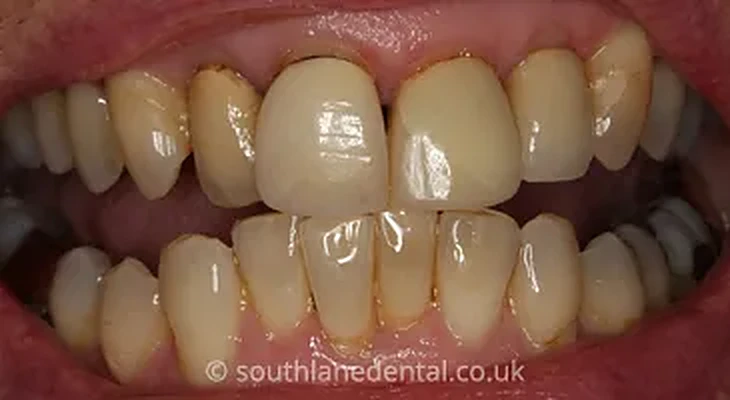 Case 4: teeth before a crown at South Lane Dental