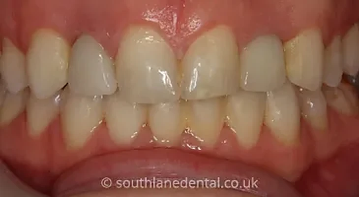 Case 5: teeth before dental implants at South Lane Dental