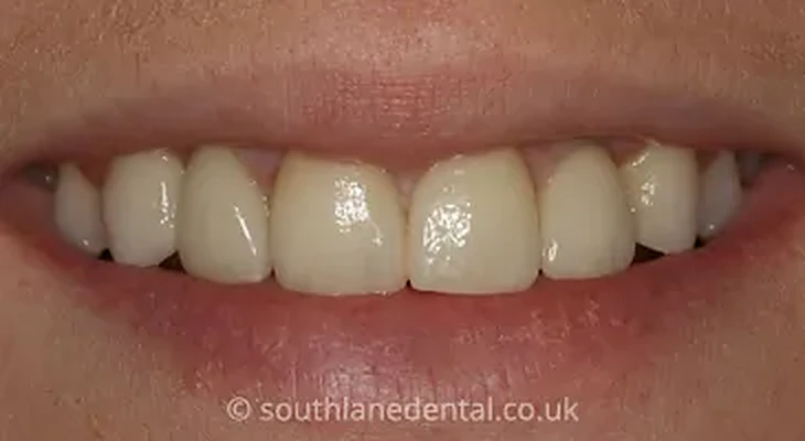 Case 6: teeth after dental implants at South Lane Dental