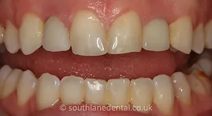 Case 6: teeth before dental implants at South Lane Dental