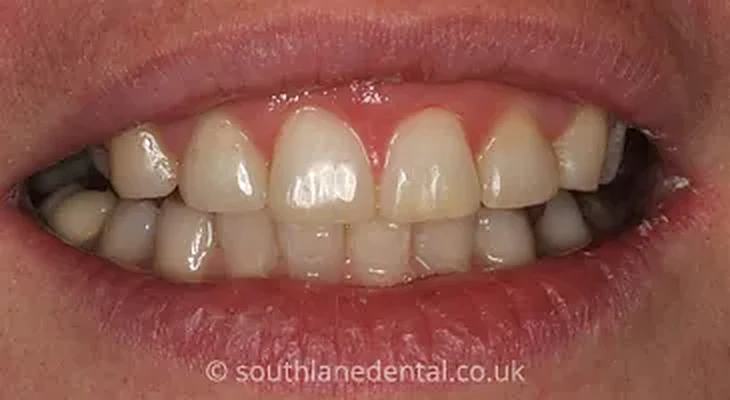 Case 7: teeth after Inman Aligner treatment at South Lane Dental