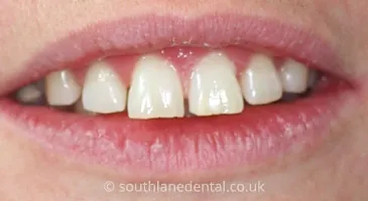 Case 7: teeth before Inman Aligner treatment at South Lane Dental