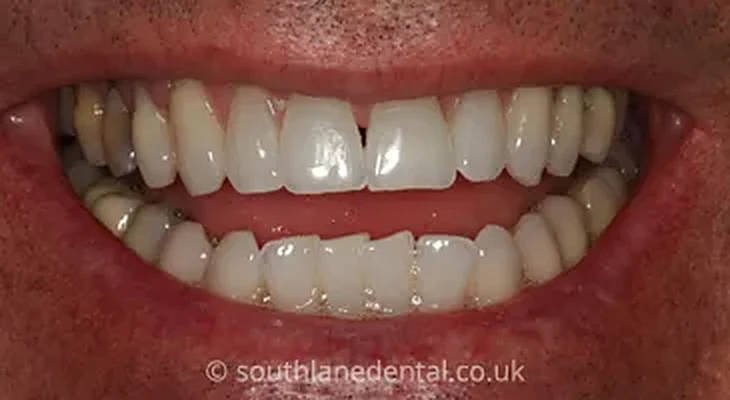 Case 8: teeth after Inman Aligner treatment at South Lane Dental