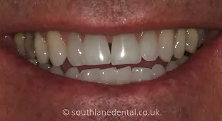 Case 8: teeth before Inman Aligner treatment at South Lane Dental
