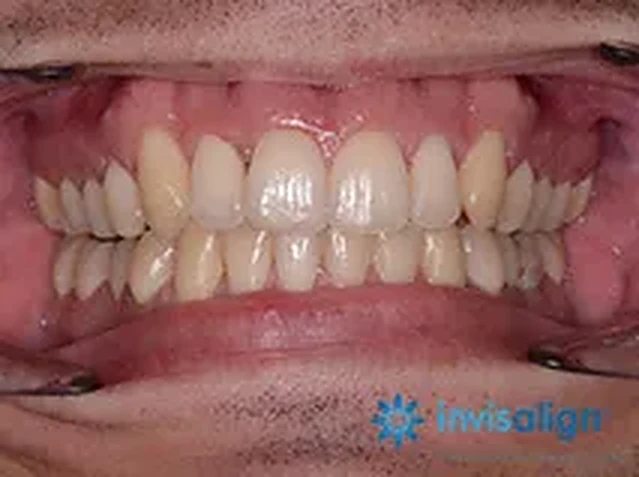 Invisalign case 1: teeth after treatment at South Lane Dental