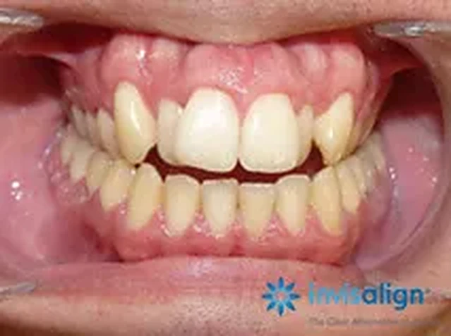Invisalign case 1: teeth before treatment at South Lane Dental