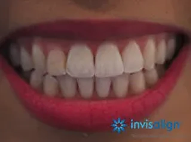 Invisalign case 2: teeth after treatment at South Lane Dental