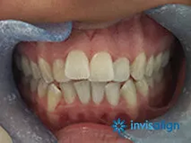 Invisalign case 2: teeth before treatment at South Lane Dental