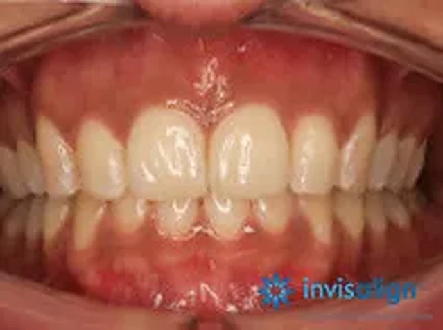 Invisalign case 3: teeth after treatment at South Lane Dental