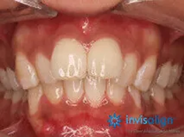 Invisalign case 3: teeth before treatment at South Lane Dental