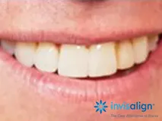 Invisalign case 4: teeth after treatment at South Lane Dental