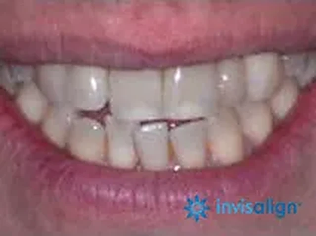 Invisalign case 4: teeth before treatment at South Lane Dental