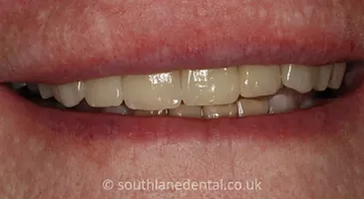 Case 10: teeth after a smile makeover at South Lane Dental