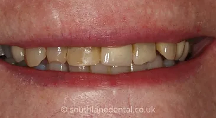 Case 10: teeth before a smile makeover at South Lane Dental