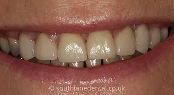 Case 11: teeth after a smile makeover at South Lane Dental