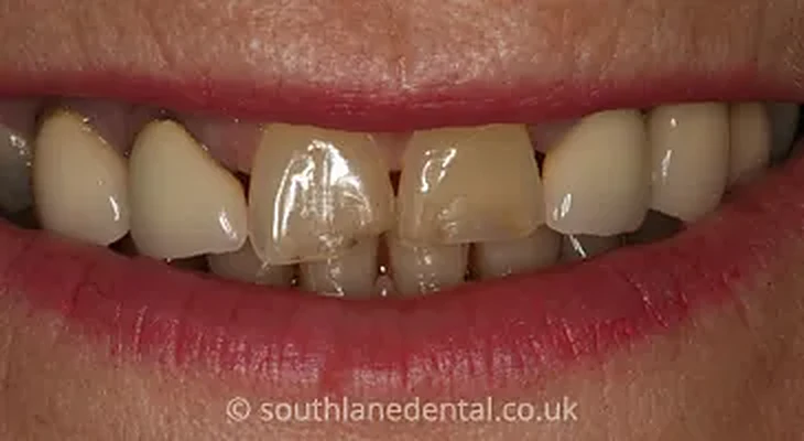 Case 11: teeth before a smile makeover at South Lane Dental