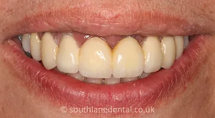 Case 12: teeth after a smile makeover at South Lane Dental