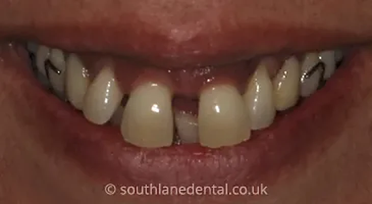Case 12: teeth before a smile makeover at South Lane Dental