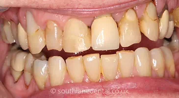Case 9: teeth before a smile makeover at South Lane Dental