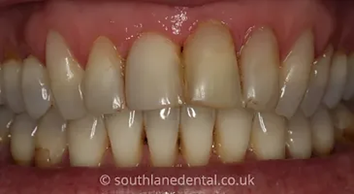 Case 13: teeth before porcelain veneers at South Lane Dental