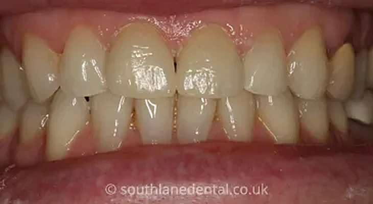 Case 14: teeth after porcelain veneers at South Lane Dental