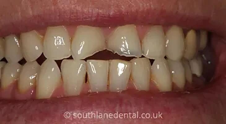 Case 14: teeth before porcelain veneers at South Lane Dental