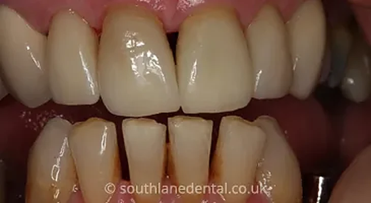 Case 15: teeth after porcelain veneers at South Lane Dental