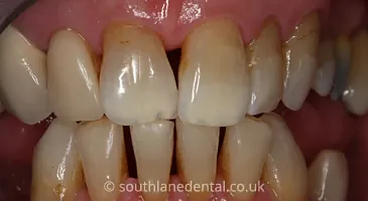 Case 15: teeth before porcelain veneers at South Lane Dental