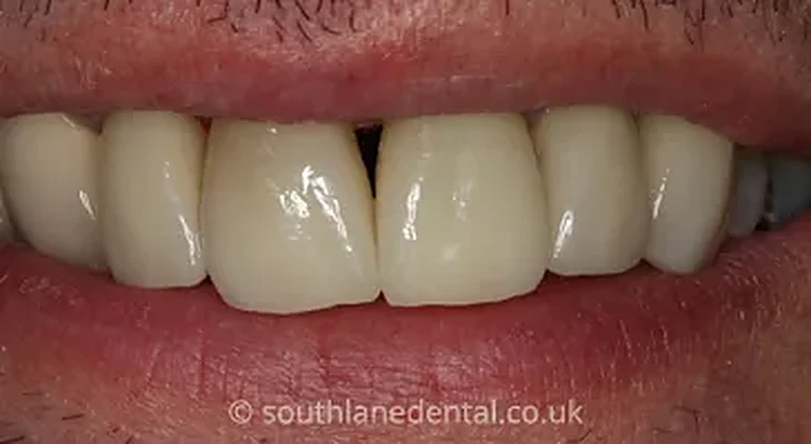 Case 16: teeth after porcelain veneers at South Lane Dental