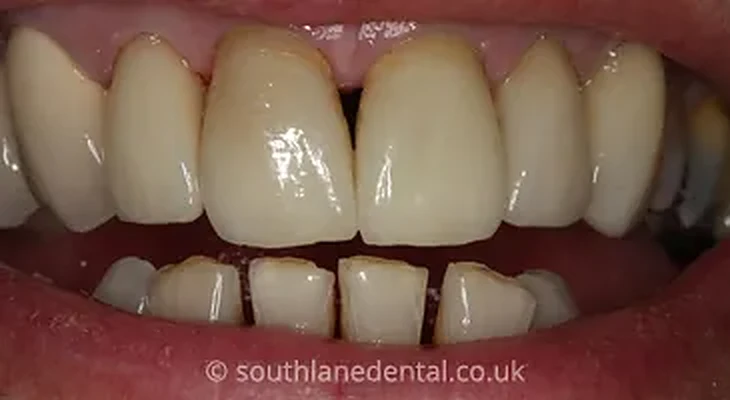 Case 16: teeth before porcelain veneers at South Lane Dental