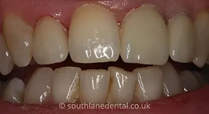 Case 17: teeth after porcelain veneers at South Lane Dental