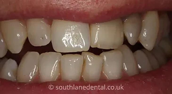 Case 17: teeth before porcelain veneers at South Lane Dental