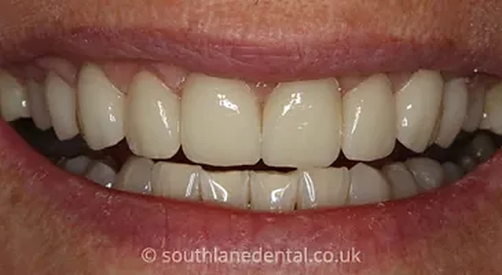 Case 18: teeth after porcelain veneers at South Lane Dental