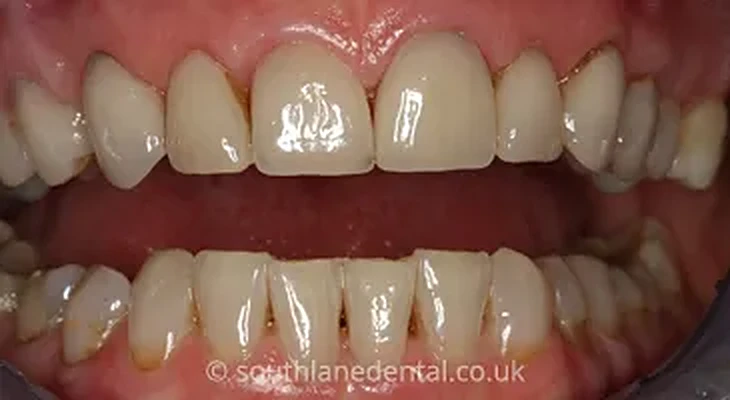 Case 18: teeth before porcelain veneers at South Lane Dental
